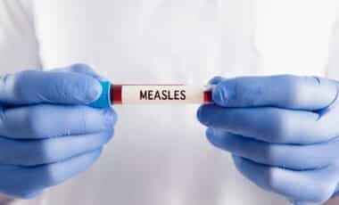 Deadly Measles Outbreak Spreads Rapidly in WA