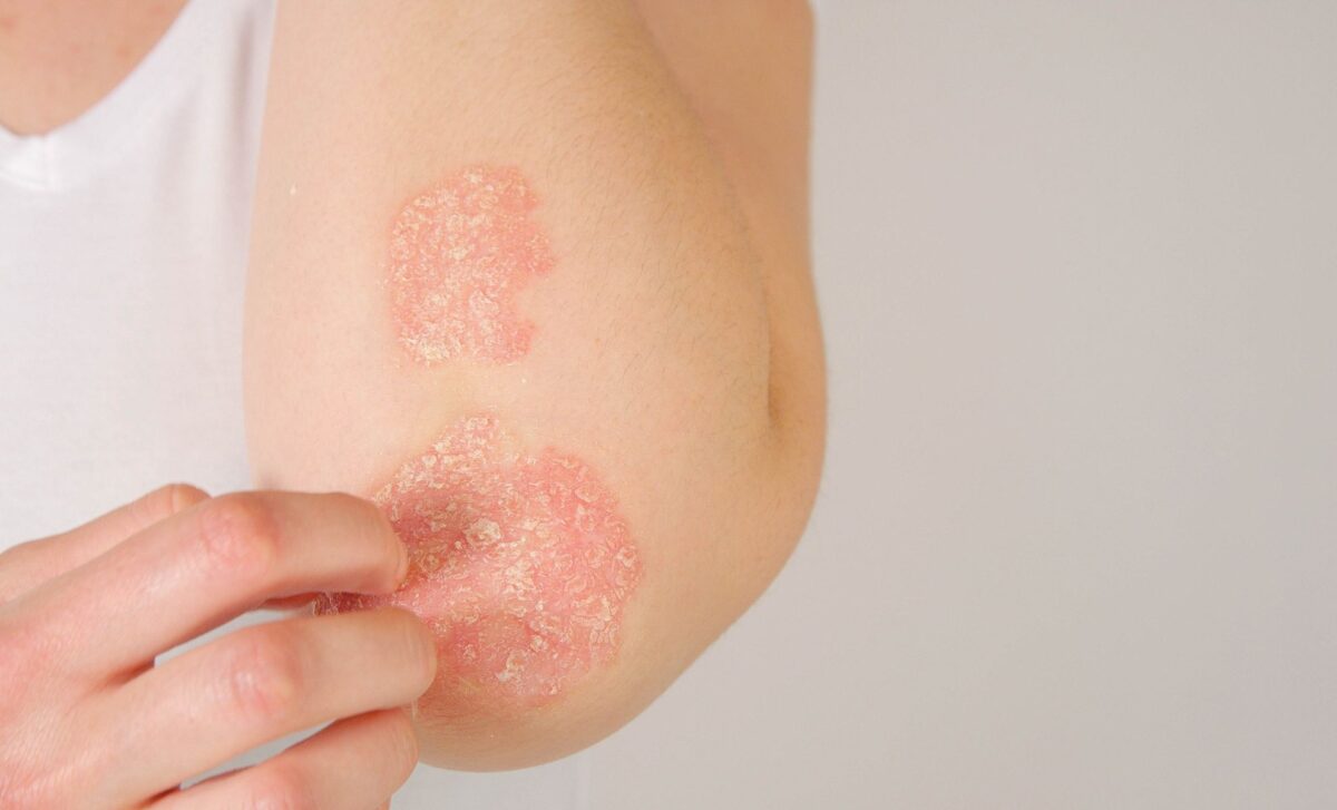 DWP Reveals 24 Skin Conditions That Could Unlock £114 Weekly PIP Payments