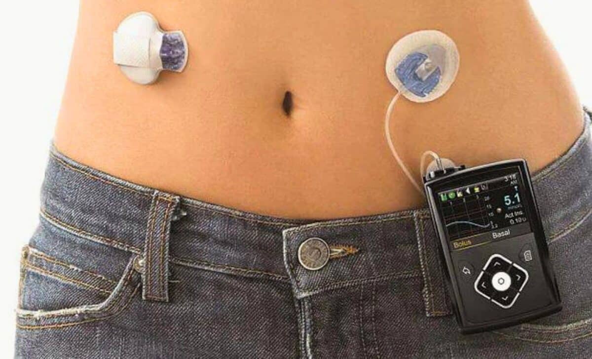 An Artificial Pancreas To Manage Type 1 Diabetes