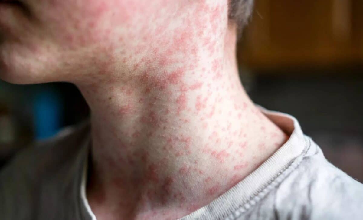 Measles in texas