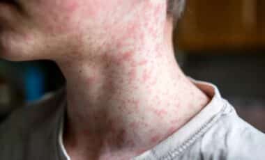 Measles in texas